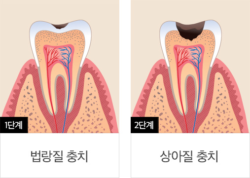 충치치료