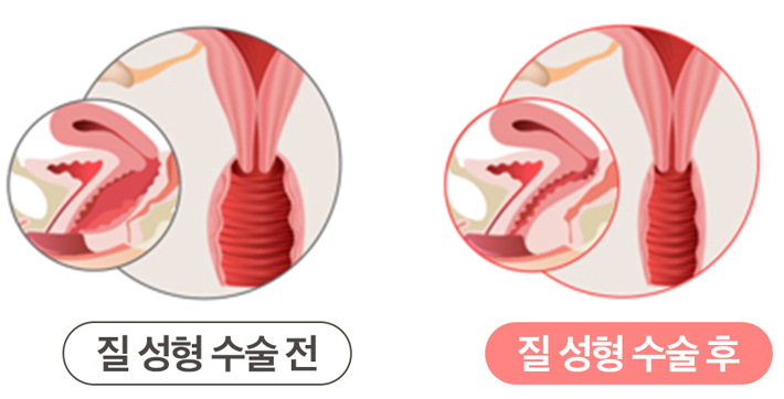 질 성형 수술 전후 비교