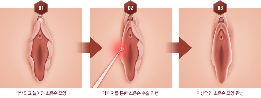 착색되고 늘어진 소음순 모양 → 레이저를 통한 소음순 수술 진행 → 이상적인 소음순 모양 완성