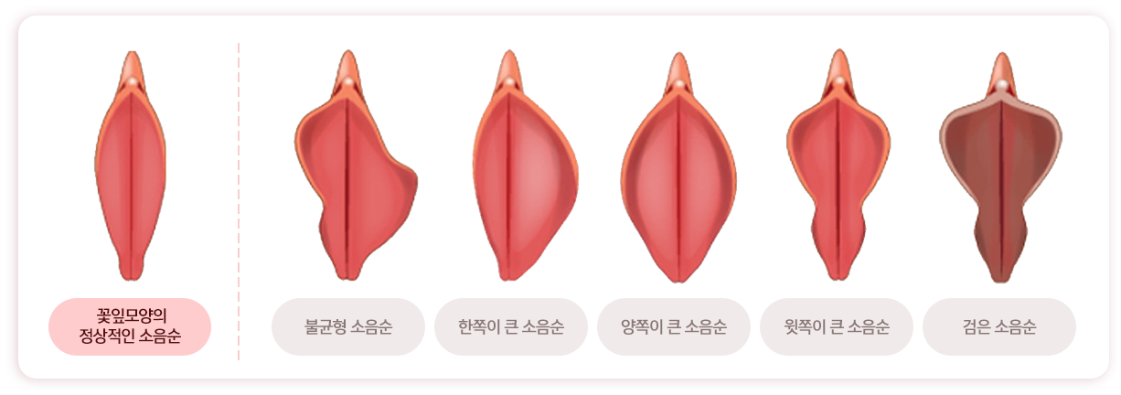 꽃잎모양의 정상적인 소음순 / 불균형 소음순 / 한쪽이 큰 소음순 / 양쪽이 큰 소음순 / 윗쪽이 큰 소음순 / 검은 소음순