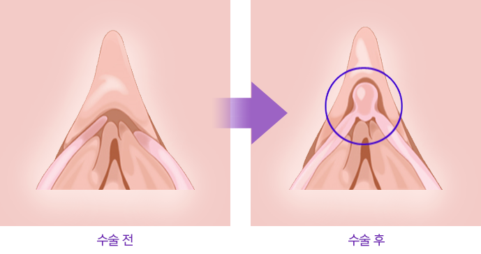 수술 전 / 수술 후 비교