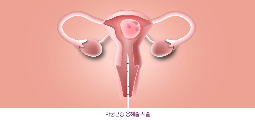 자궁근종 용해술 시술
