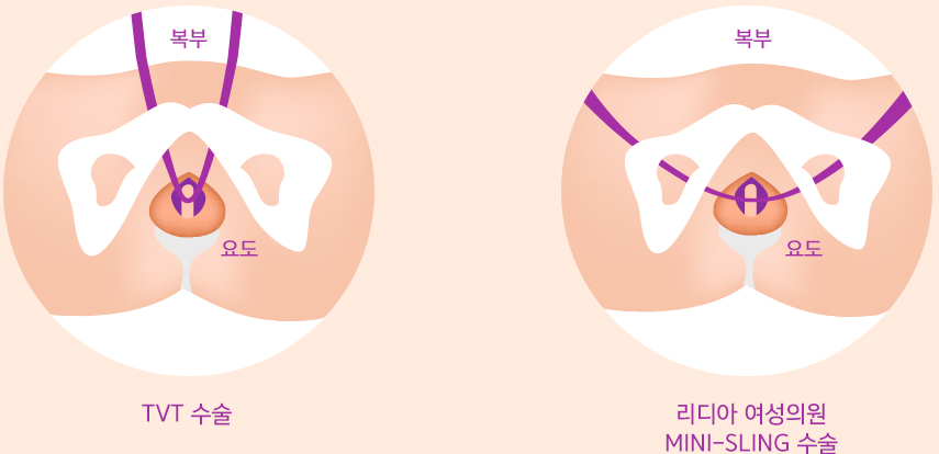 TVT 수술 vs 리디아 여성의원 MINI-SLING 수술 비교