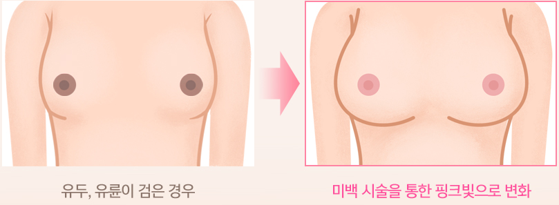유두, 유륜이 검은 경우 → 미백 시술을 통한 핑크빛으로 변화